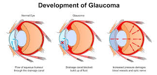 How to Tell if You Have Glaucoma