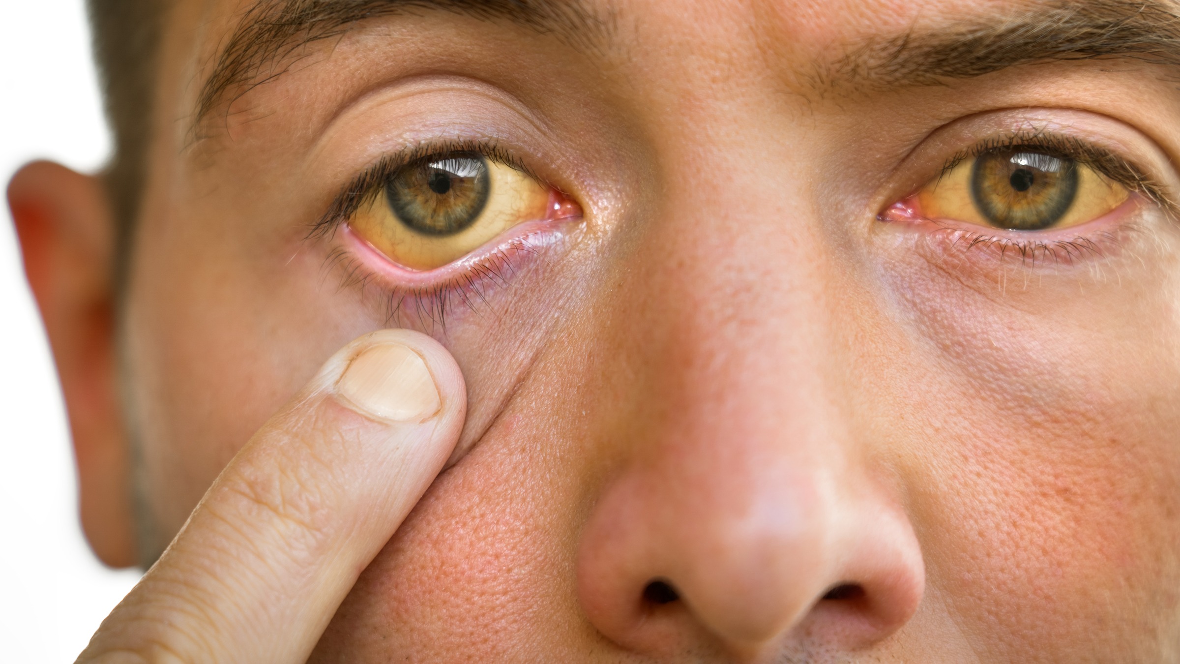 What Causes Yellow Eyes? - Access Eye